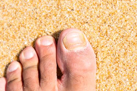 Comment soigner les mycoses sur les ongles des pieds ? Votre pédicure vous répond !