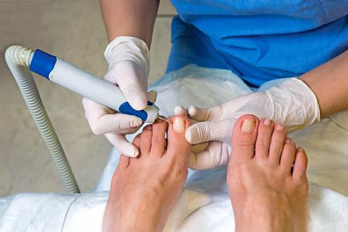Jeremy Saal, pédicure à Livry-Gargan vous débarasse de votre ongle incarné! 
